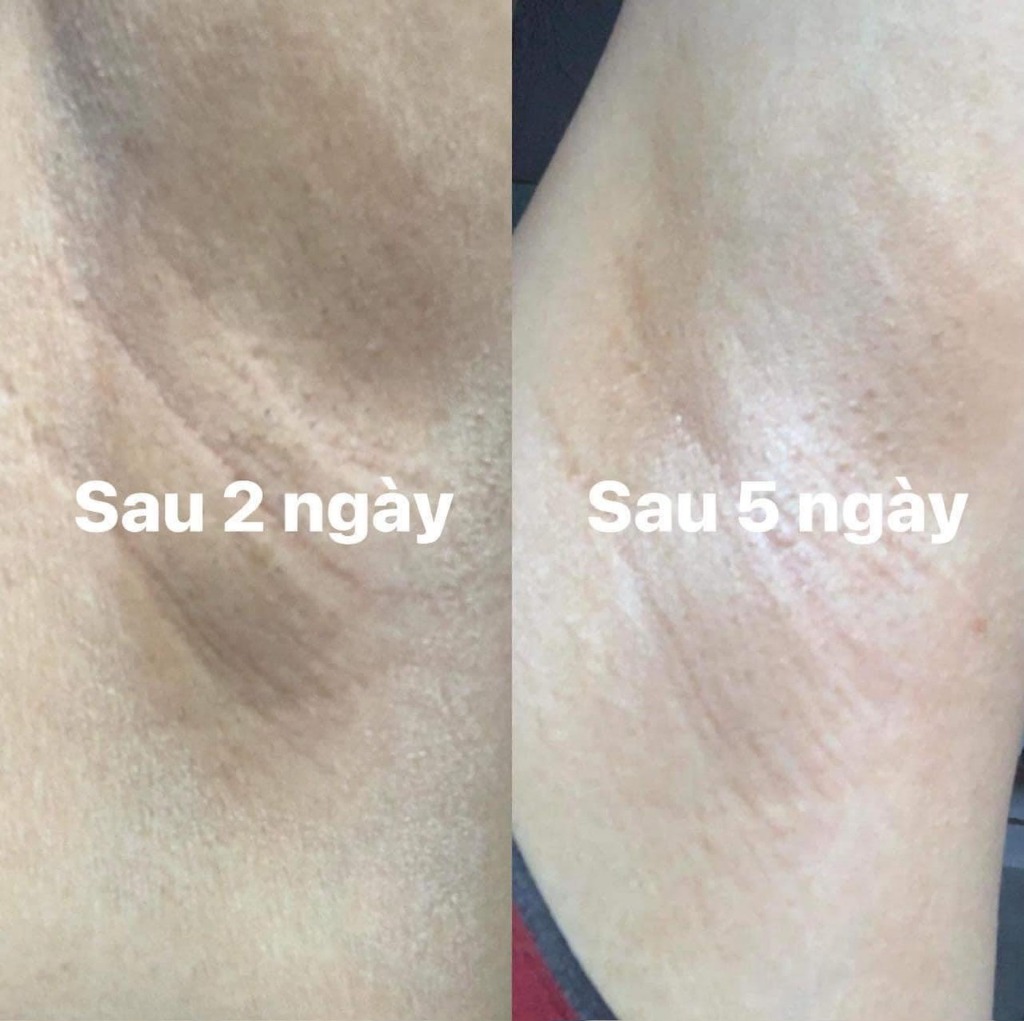 Kết quả trị thâm nách sau 2 ngày và 5 ngày dùng serum Vietcosmetic