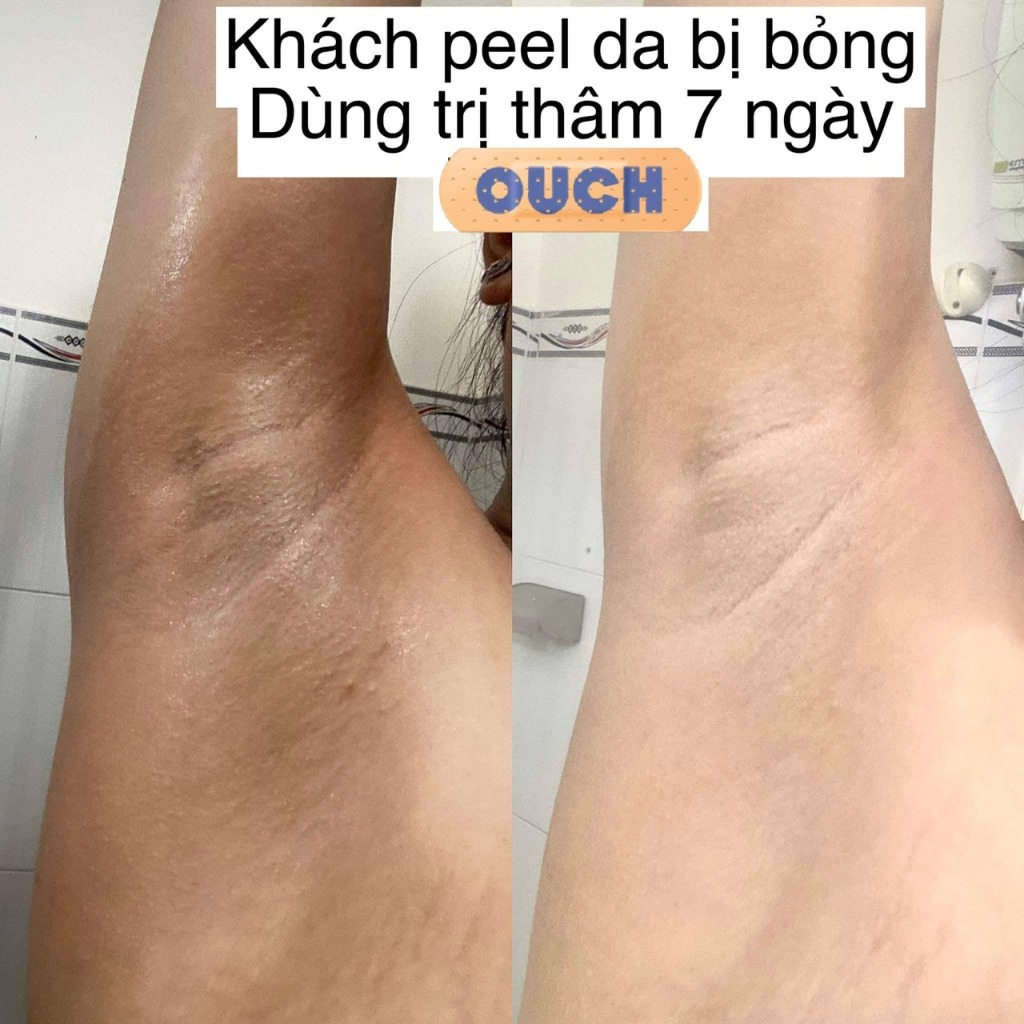 Khách peel da bị bỏng, dùng serum trị thâm 7 ngày da sáng mịn