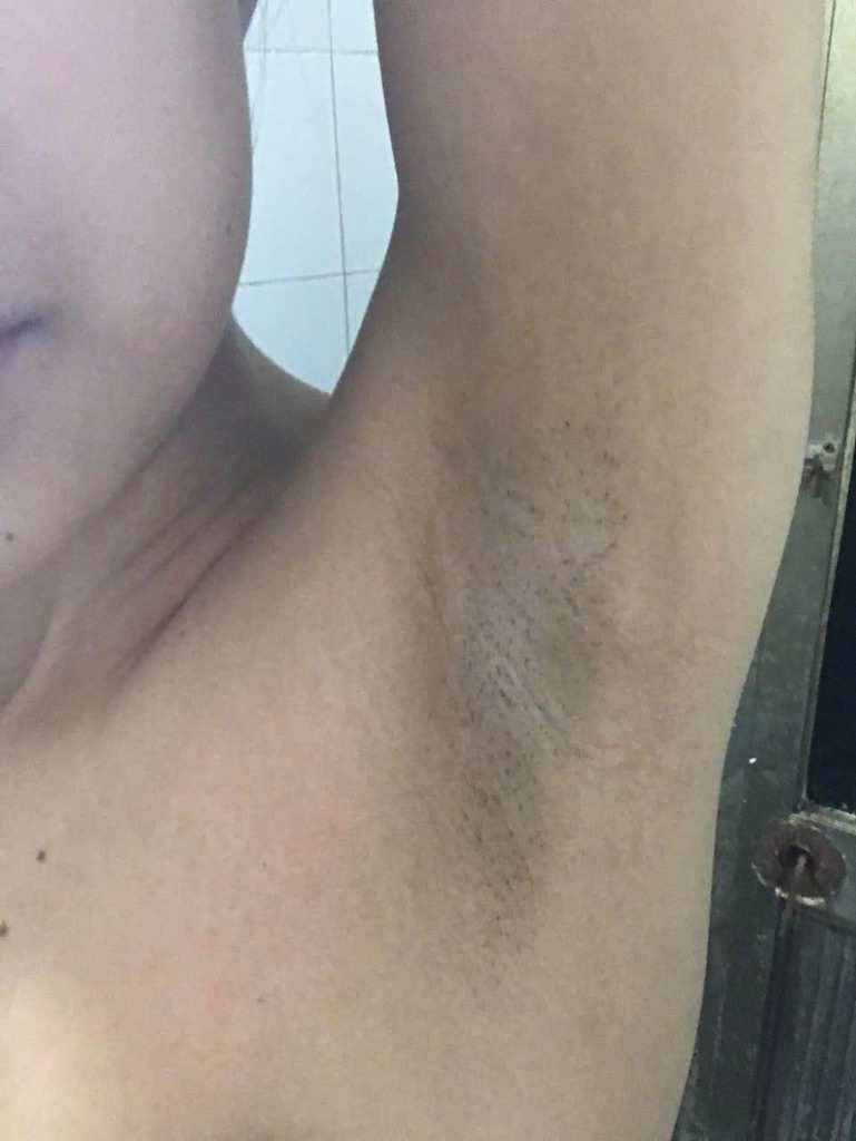 Thâm nách trước khi dùng serum Vietcosmetic